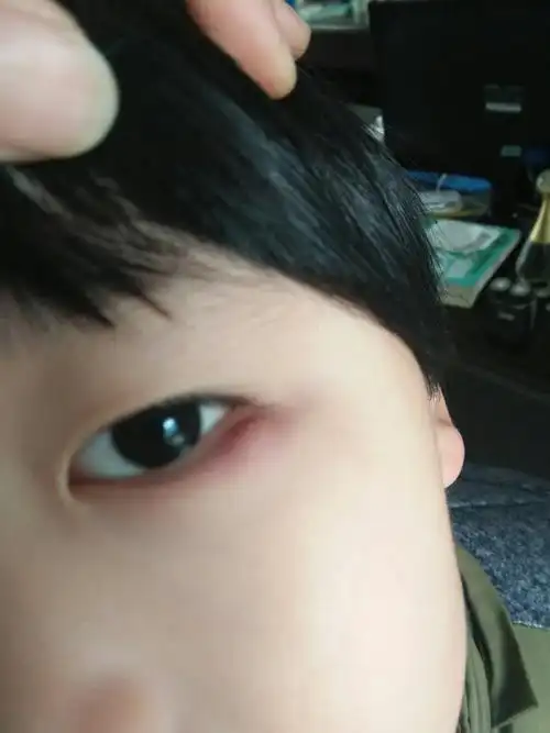 医生有没有,帮看看小孩眼下方长的是什么,这怎么回事