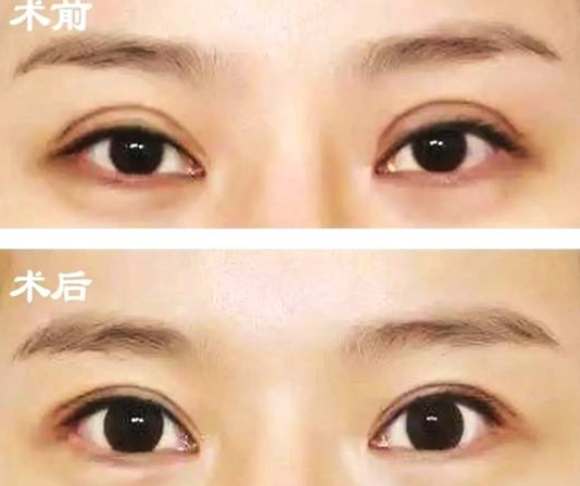成镇模院长解析双眼皮为什么会有肉条眼修复效果对比