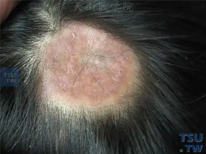 深在性红斑狼疮症状表现