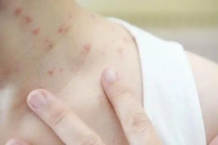 艾滋病片女银屑病的症状图片