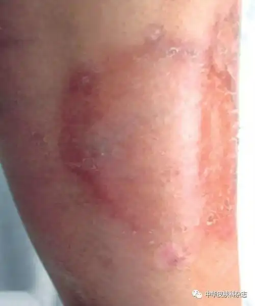 类脂质渐进性坏死一例