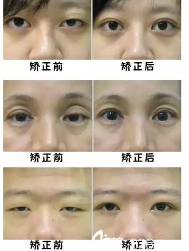上睑下垂矫正手术前后对比案例