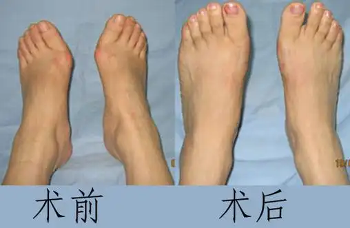 【患者】:李女士,女,53岁   【病史】:今年53岁的李女士,受拇外翻