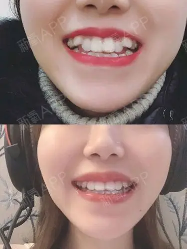 虎牙矫正第31副啦～效果太棒 自己看吧.