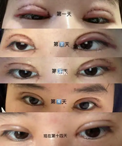 双眼皮手术