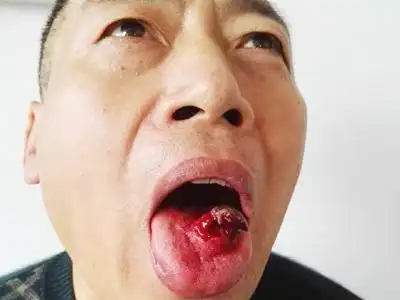 轻微舌癌图片50
