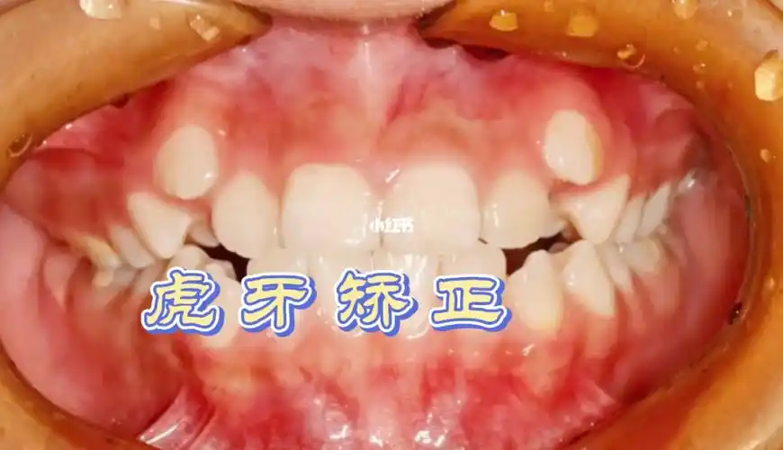 虎牙也叫犬齿虽然大家都说虎牙可爱