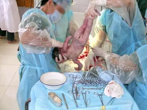 男人们看看剖腹产图