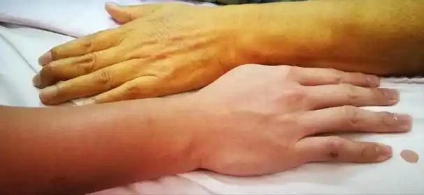 什么是黄疸为什么皮肤突然变黄学会这几招让你不变小黄人