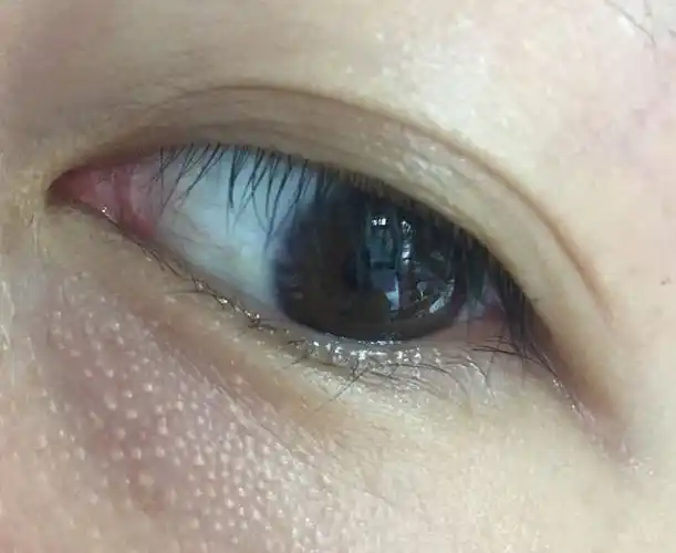 用了一周后,下眼睑开始密密麻麻地长了很多脂肪粒,她来咨询我,想问问