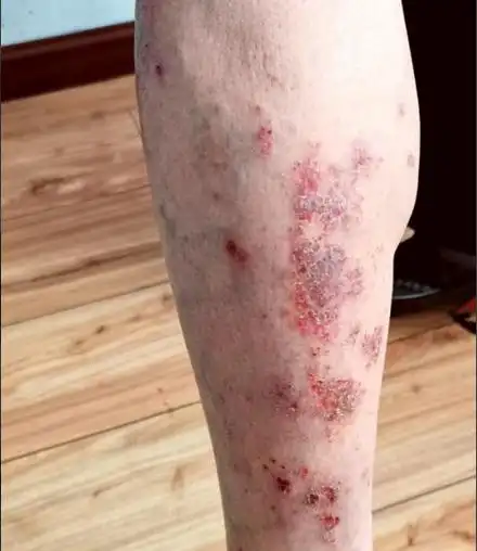 【扩散】十余年顽固湿疹缠绵难愈——经典中医凸显奇效