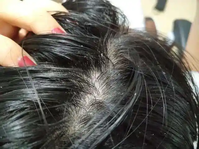 头发出油,可能是有螨虫的信号