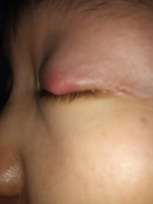 眼睛上长了一个痘痘,这是什么东西,有点硬,按着疼.