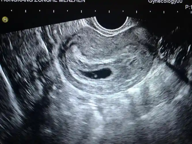 6w接到胎心胎芽啦0101