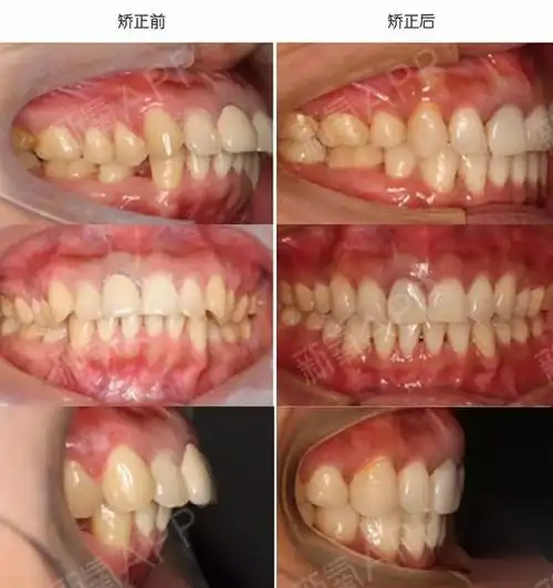 厦门医生案例:1.矫正前后面像对比_圈子-新氧美容整形