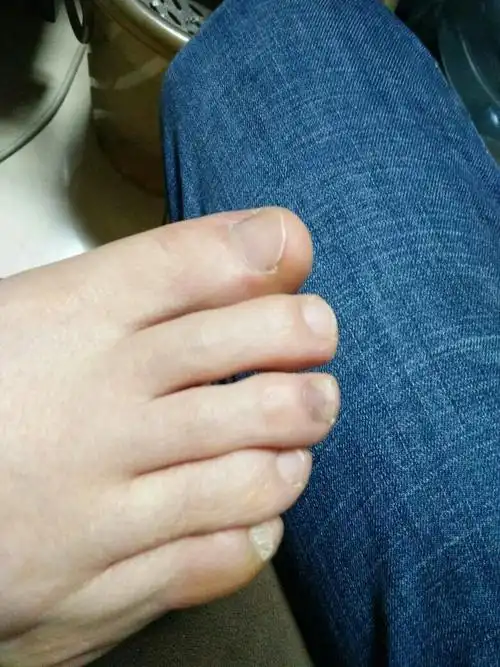 中脚趾这样,是什么情况?