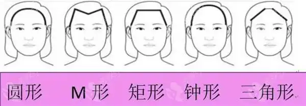 发际线各种不良形状