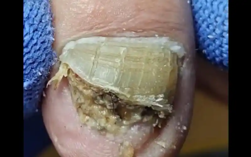 指甲里面烂掉了,都快长虫子了