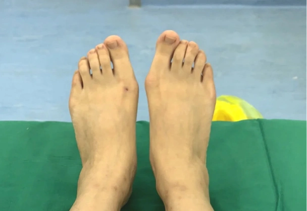 导语:拇外翻又叫"大脚骨",通常是指脚趾的第一跖骨的关节向外移动