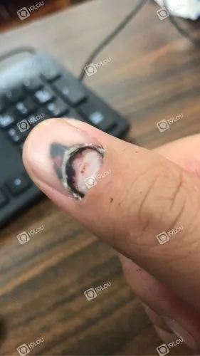 整个指甲盖像脱壳一样的好吓人