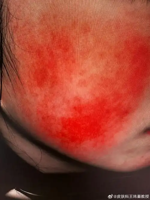 导致面部皮肤发红的原因很多,主要包括:敏感性皮肤,玫瑰痤疮,接触性