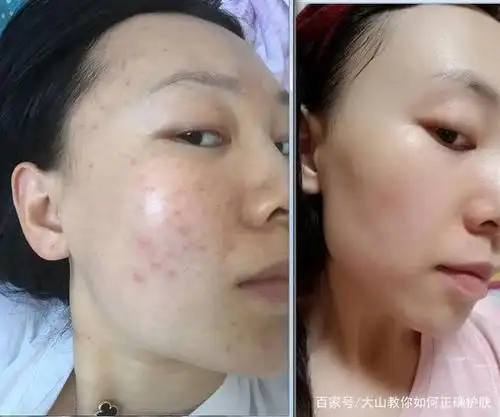 说说和祛痘的那些事,原来祛痘可以这么简单