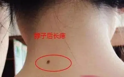 脖子后边有痣解释之一:后脖子有痣,表示有靠山,做工作,经商都能有贵人