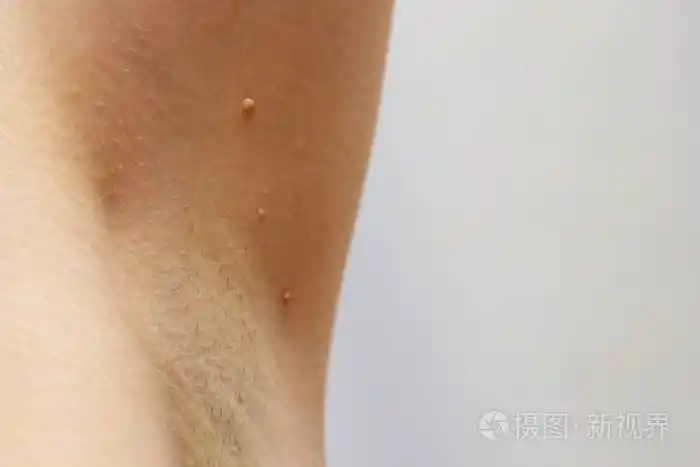 腋窝皮肤乳头状瘤特写