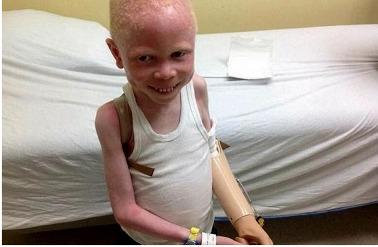 这是一个坦桑尼亚的小男孩,他十分不幸,天生患有白化病,并且还刚刚