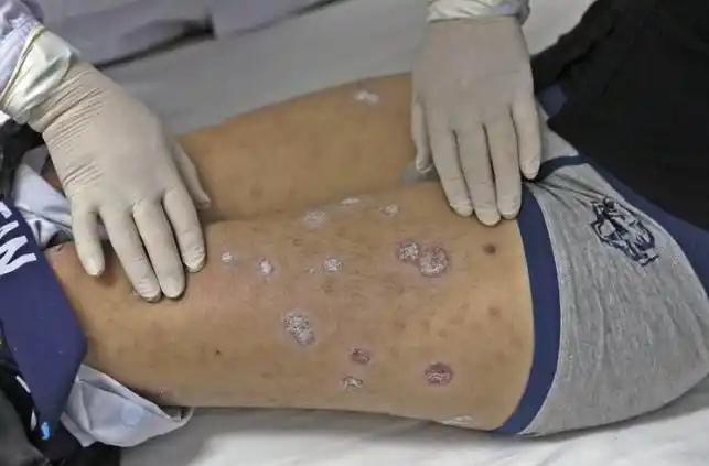 梅毒有什么症状 感染梅毒有什么症状