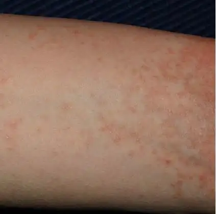 疥疮的症状有哪些?