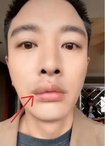 贾乃亮嘴唇被毒蚊子叮咬变香肠自我调侃称特别性感