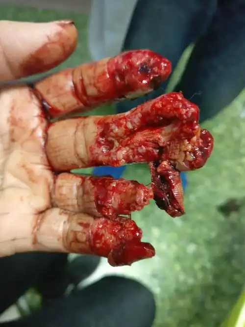 压面机压烂手指 为保全"种"在腹内