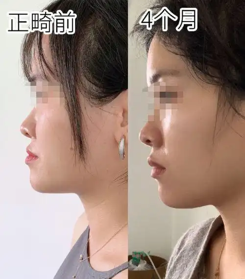 地包天做了牙齿矫正后,从侧脸是能够看到最明显变化的.