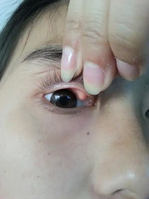 包,不痛不痒,也感觉不到,不把眼皮翻开也看不出来,两只眼睛都长有一个