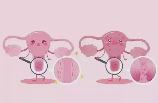 宫颈癌术后8年她再次患上阴道癌hpv感染仍需注意