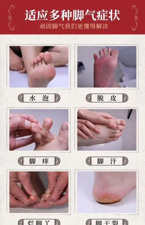 云南本草脚气喷剂止痒膏脱皮脚丫脚臭脚痒泡脚水烂抑菌杀菌除水泡_全