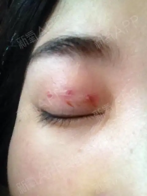 拆线后,线结反应.很大一块鼓包.直接是6个窟窿.[_圈子-新氧美容整形