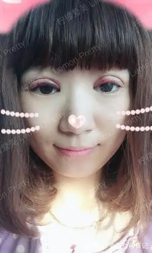 萌妹子做"埋线双眼皮"1个月后,室友夸我眼睛变大,有神了!