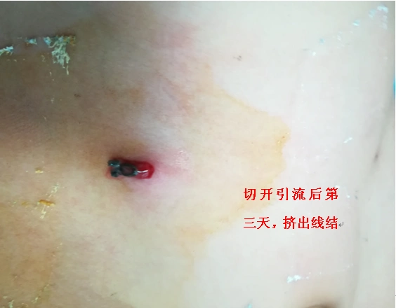 可扪及的结节(皮下结节期),部分患儿可长期稳定在此阶段,无临床症状