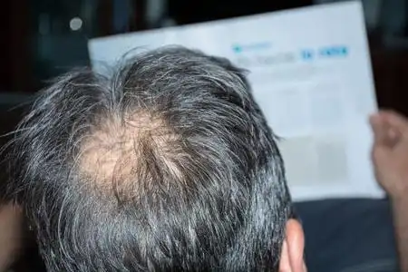 掉头发的男人图片