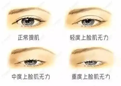 提肌无力和上眼睑下垂的区别挺大矫正手术的费用也不同