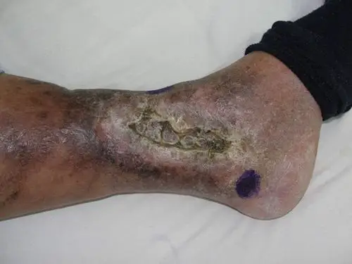 败血症图片 (84)