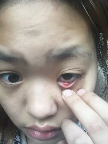 眼睛下眼皮里面长一个痘痘,怎么办啊,要不要去医院