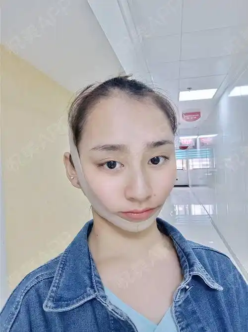 拉皮手术提升术后7天_紧致提升术后7天_除皱抗衰老术后7天_杨杨佳分享