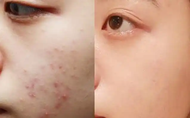 油痘肌敏感肌如何正确护肤?生活细节很关键,清洁工作要做好!