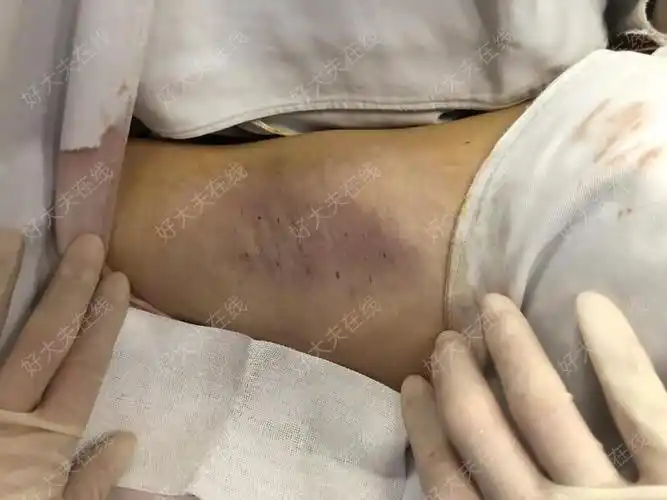 腋臭微创术后即刻,手术疤痕不明显