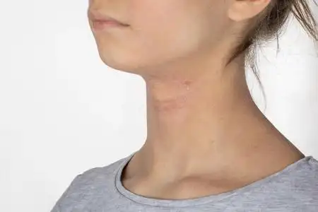 过敏性皮炎湿疹图片