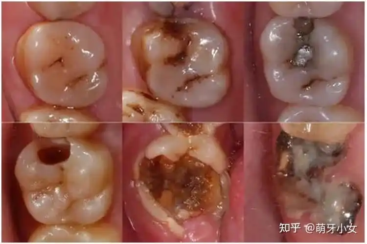 牙齿上烂了个洞不去补牙会怎样