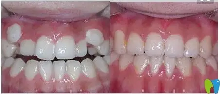 王涪华医生成人虎牙矫正前后对比案例图